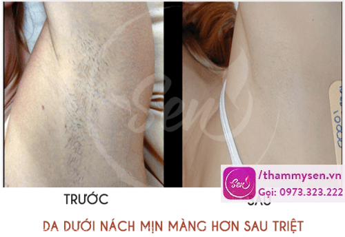 Vùng da được trẻ hóa sau khi triệt lông nách