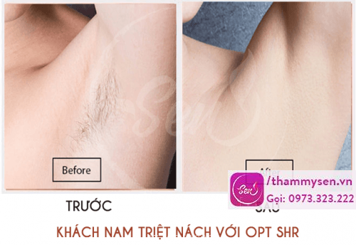 Kết quả triệt lông nách vĩnh viễn của khách hàng nam giới