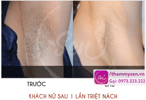 Lông nách mọc ngắn hơn sau khi triệt lông nách vĩnh viễn 1 buổi