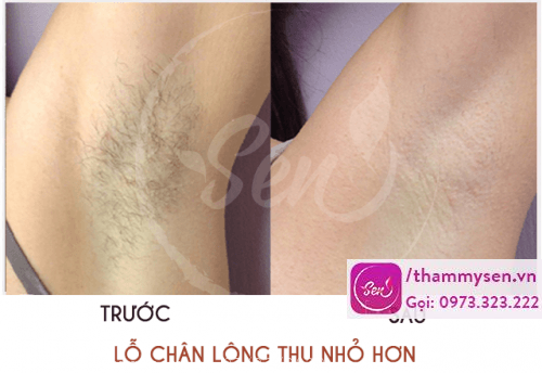 Lỗ chân lông thu nhỏ sau khi triệt nách vĩnh viễn