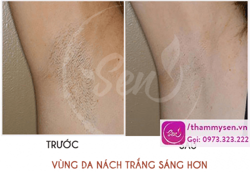 Da vùng nách trắng hơn sau khi triệt lông nách
