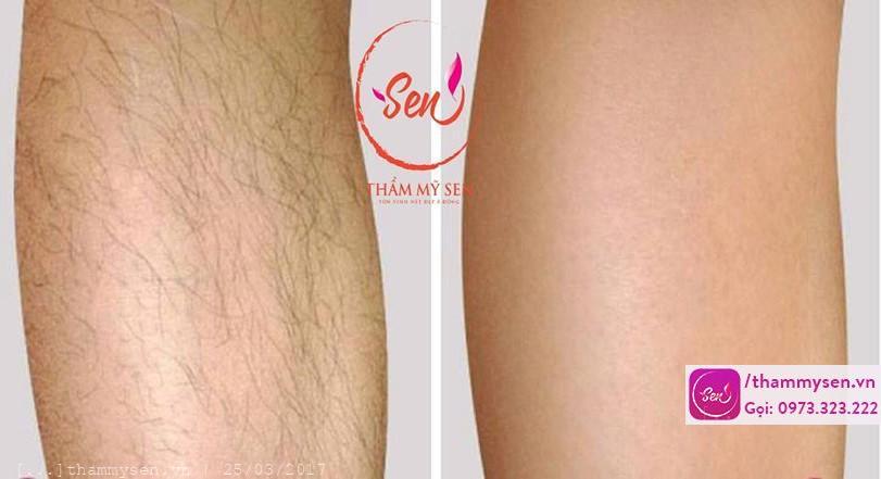 Có nên triệt lông hiệu quả không