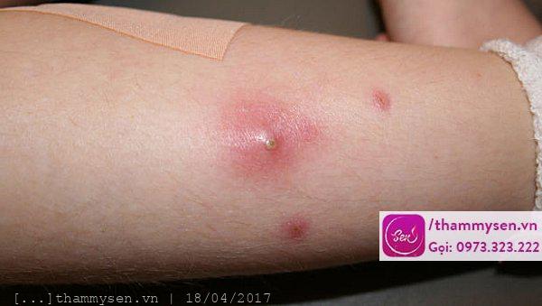 Cách chữa mụn nhọt