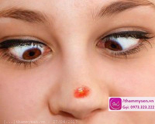 Nguyên nhân gây nên mụn học ở mũi Cách trị mụn bọc ở mũi