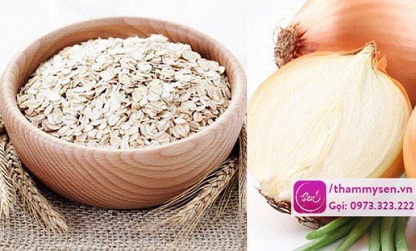 Trị mụn bằng hành tây 