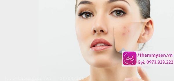 Trị mụn bằng hồ nước tại nhà