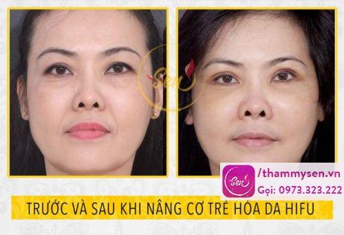 kết quả nâng cơ trẻ hóa da mặt hifu