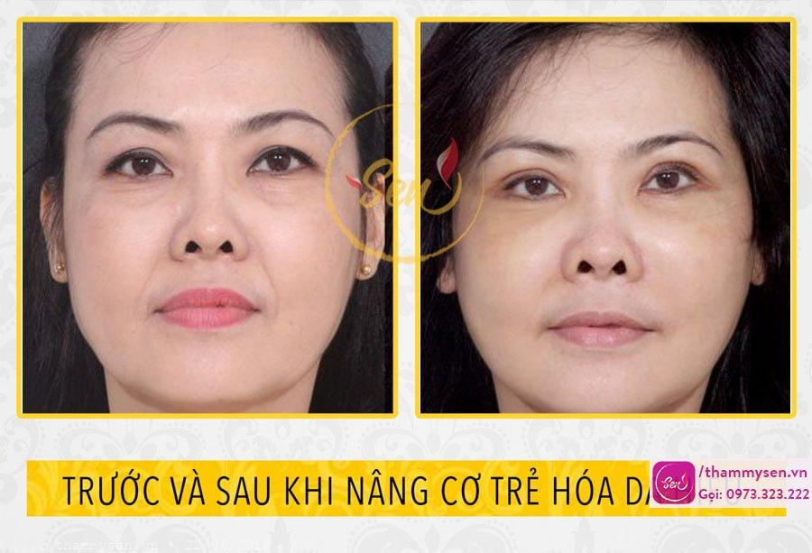 căng da mặt không phẫu thuật