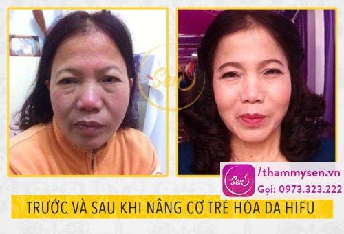 kết quả nâng cơ trẻ hóa da mặt hifu