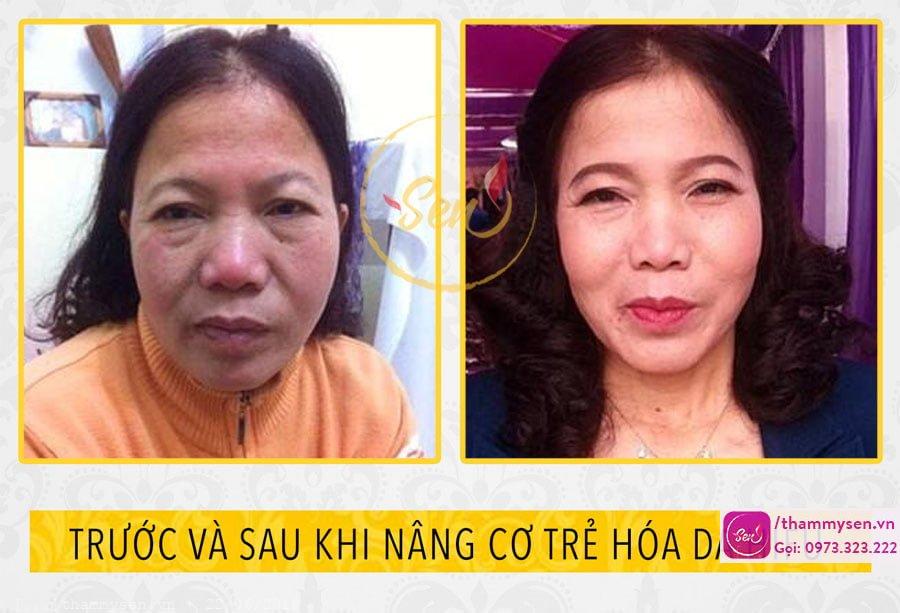 kết quả nâng cơ trẻ hóa da mặt hifu