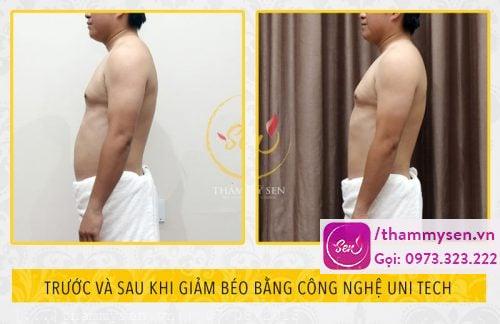 giảm béo toàn thân bàng công nghệ unitech tại thẩm mỹ sen