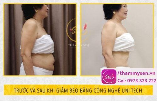 Cô Hoa sau khi dùng liệu trình giảm béo toàn thân công nghệ cao Uni Tech.