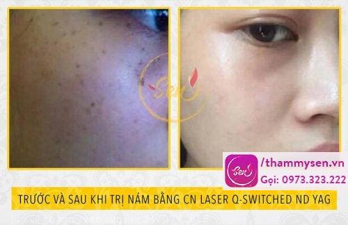Kết quả sau liệu trình trị nám