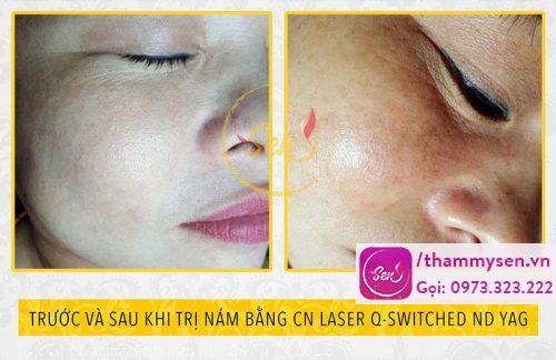 Kết quả sau liệu trình trị nám
