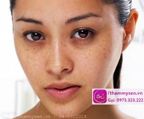 Quy trình trị nám LASER Q-SWITCHED ND YAG