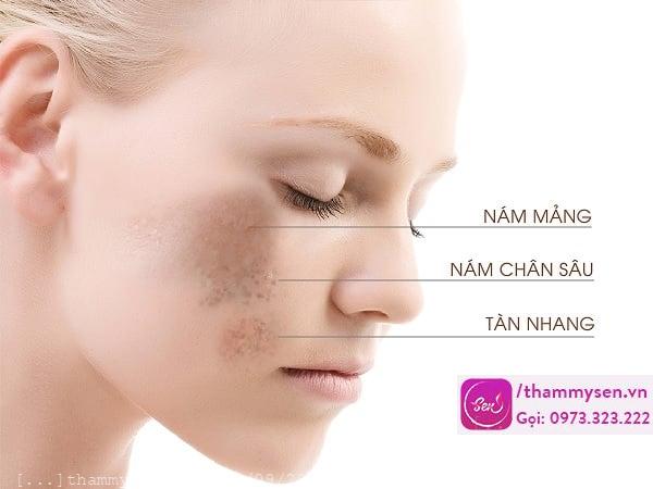 cách trị nám sau khi sinh