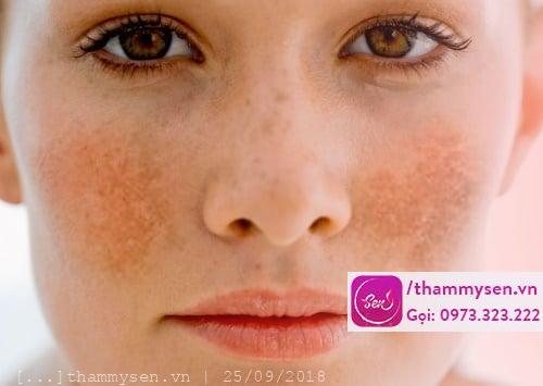 cách trị nám tốt nhất