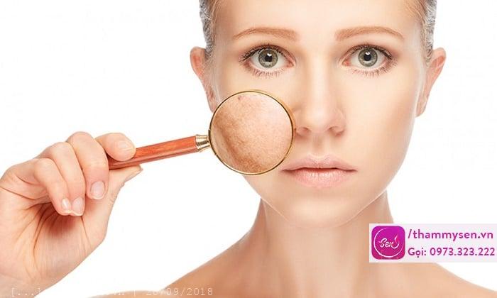 làm thế nào để hết nám dâ mặt