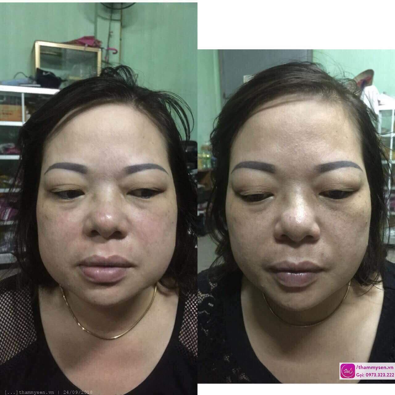 trị nám tàn nhang
