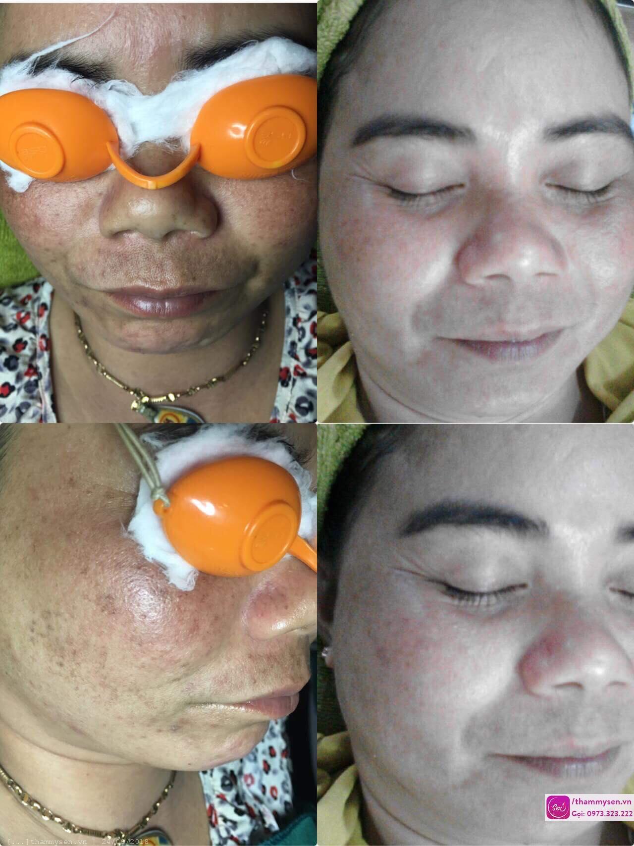 trị nám tàn nhang