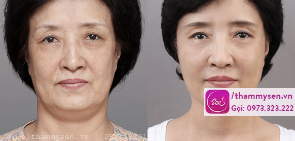 công nghệ Hifu Ultherapy
