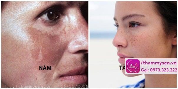 đặc trị nám tàn nhang hiệu quả