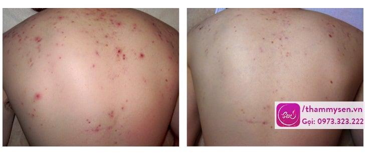 điều trị mụn lưng