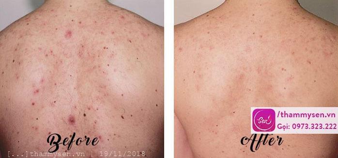 điều trị mụn lưng