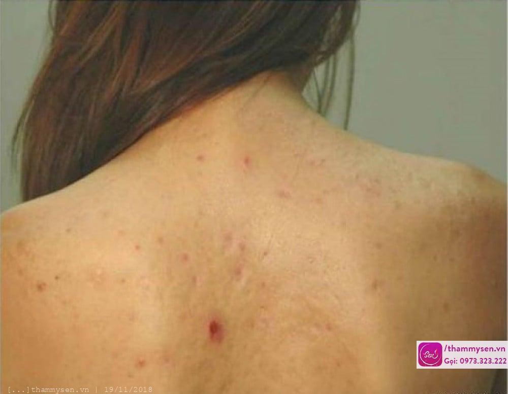 điều trị mụn lưng