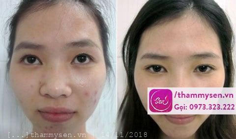 liệu trình trị mụn cơ bản