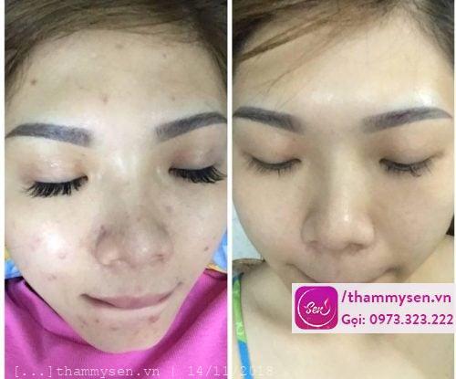 liệu trình trị mụn cơ bản