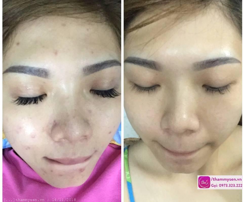 liệu trình trị mụn cơ bản