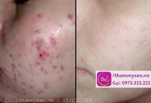 trị mụn cao cấp tinh chất cá mập