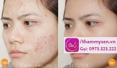 trị mụn cao cấp tinh chất cá mập