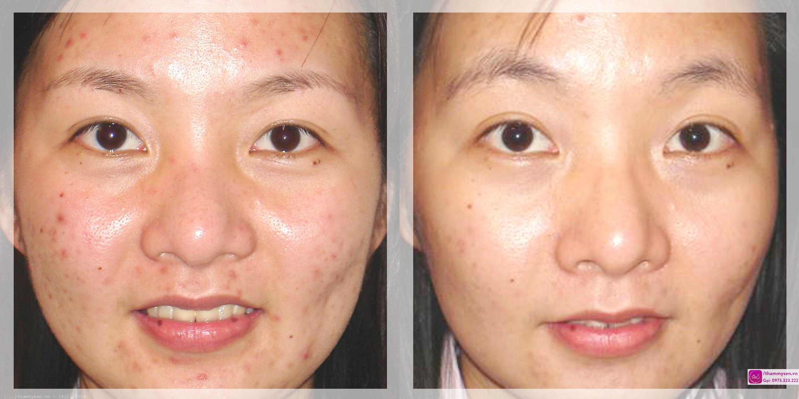 trị mụn chuyên sâu