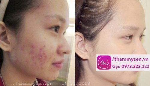 trị mụn chuyên sâu