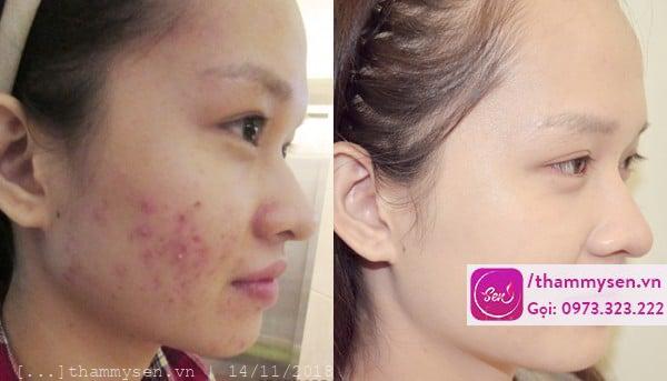 trị mụn chuyên sâu