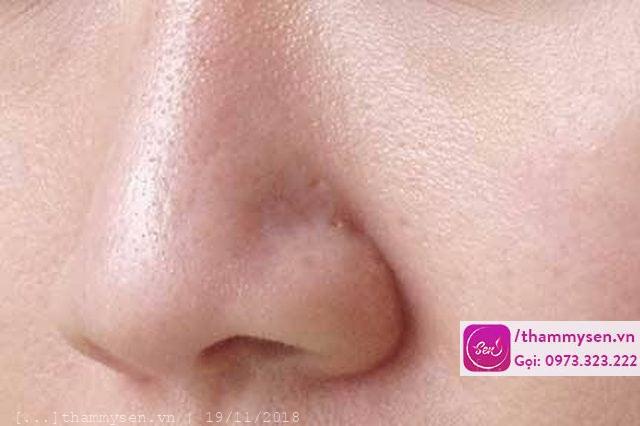 trị mụn đầu đen se khít lỗ chân lông