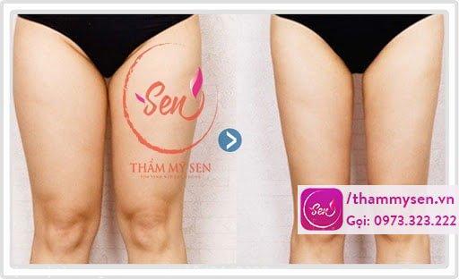 hình ảnh sau khi khách hàng sử dụng liệu trình giảm mỡ bắp chân thành công
