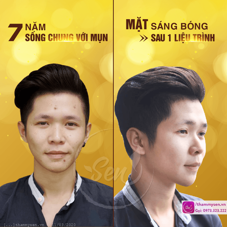 Trị mụn đầu đen hiệu quả