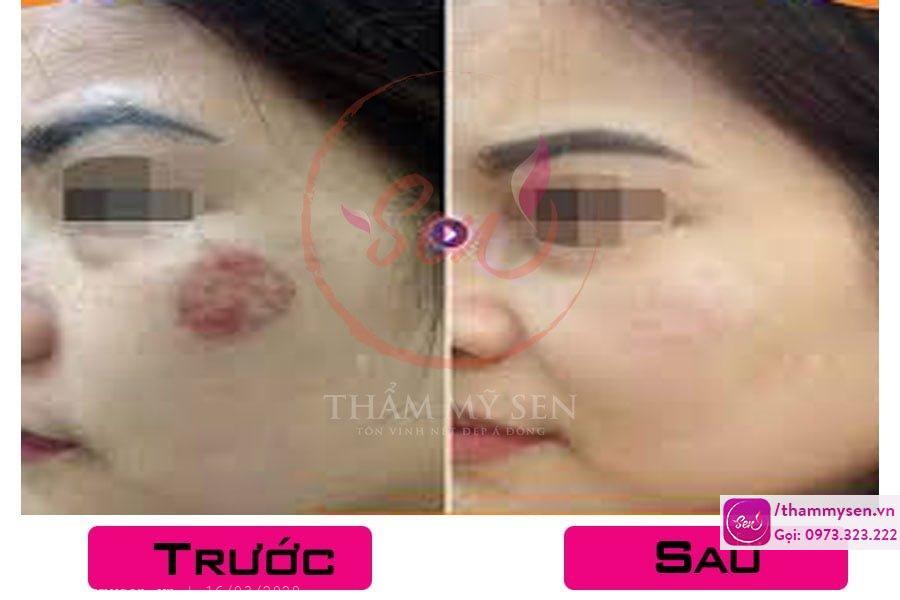 Kết quả sau điều trị sẹo lồi bằng laser của khách hàng
