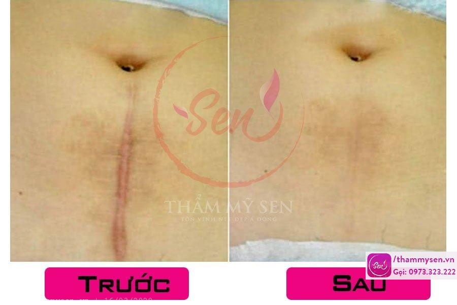Kết quả sau điều trị sẹo lồi bằng laser của khách hàng