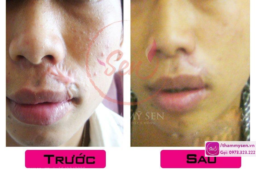 Kết quả sau điều trị sẹo lồi bằng laser của khách hàng
