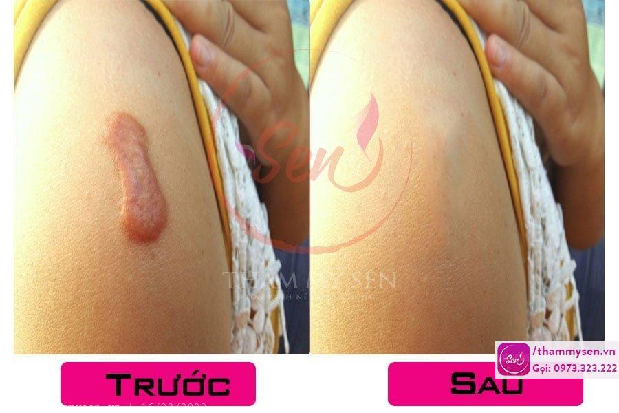 Kết quả sau điều trị sẹo lồi bằng laser của khách hàng