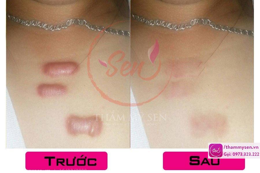 Kết quả sau điều trị sẹo lồi bằng laser của khách hàng