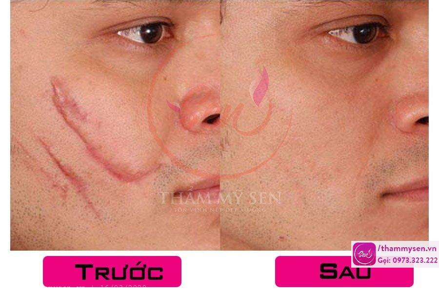 Kết quả sau điều trị sẹo lồi bằng laser của khách hàng