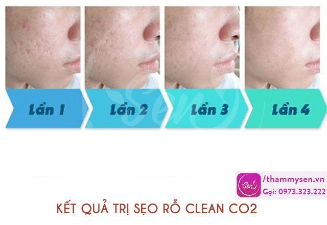 ket-qua-tri-seo-ro-seo-lom-bang-laser