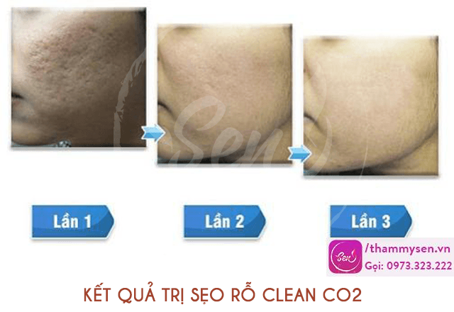 tri-seo-ro-seo-lom-bang-laser