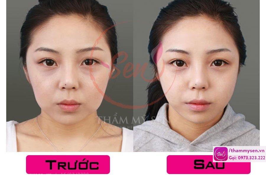 trẻ hóa bằng HIFU