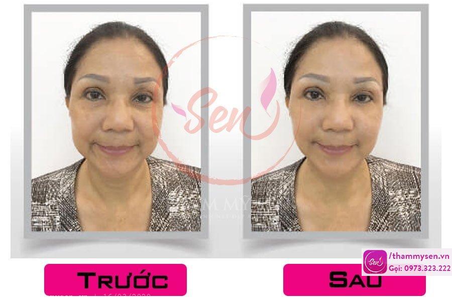 trẻ hóa bằng HIFU
